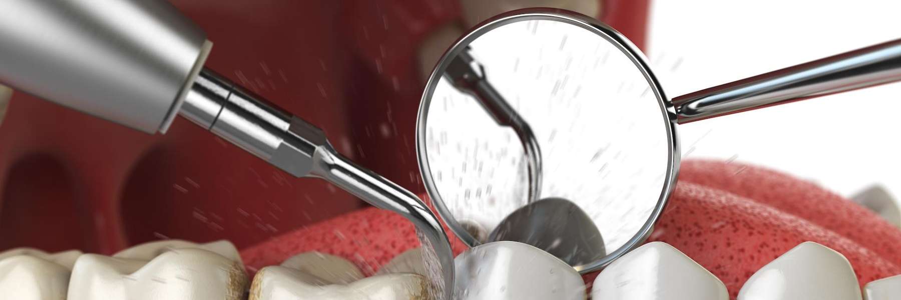 fluoride treatments miami | teeth being cleaned