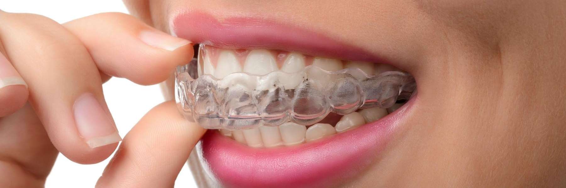 early orthodontic treatment miami | clear aligners 