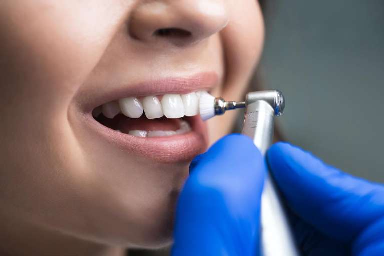 childrens dental fillings miami | patient getting teeth polished